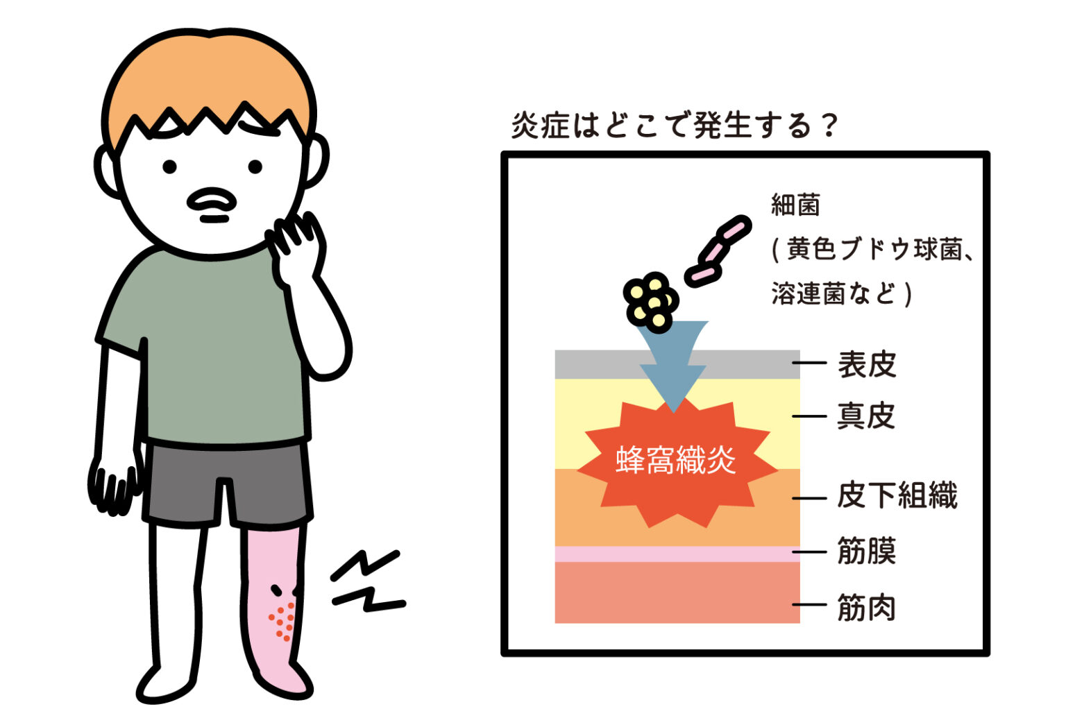 丹毒・蜂窩織炎 | 【保険適用】ヒフメド|皮フ科専門オンライン診療